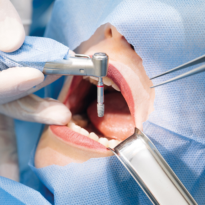 Is dental implant surgery a painful procedure Is dental implant surgery a painful procedure