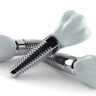 implants 5